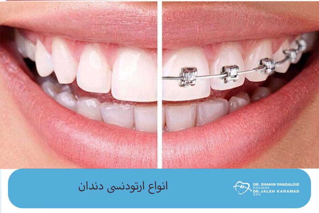 انواع ارتودنسی دندان - کلینیک تخصصی ارتودنسی دکتر شادالویی